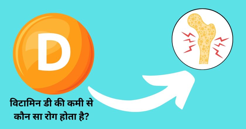 विटामिन डी की कमी से कौन सा रोग होता है? चलिए जानते है | 1 विटामिन डी की कमी से कौन सा रोग होता है चलिए जानते है